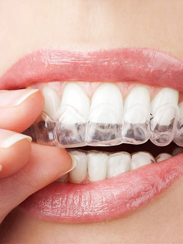 invisalign